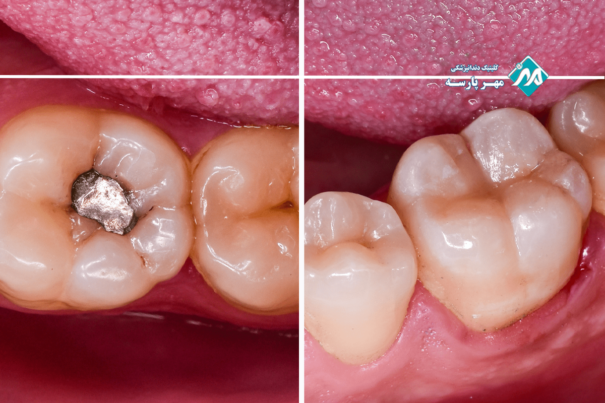 مقایسه آمالگام و کامپوزیت