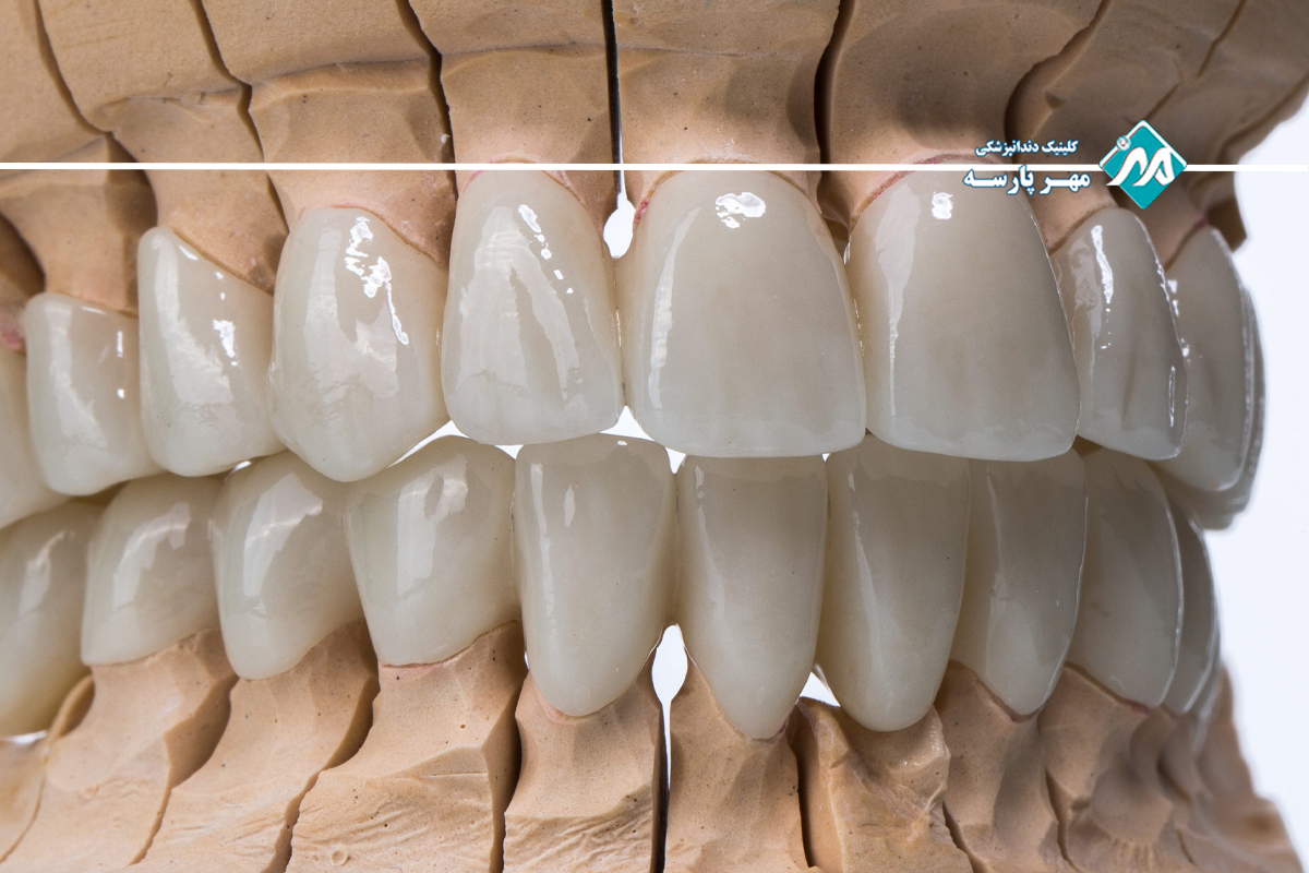 انواع لمینت دندان سرامیکی