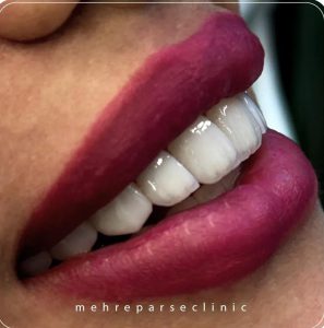 نمونه درمان لمینت دندان