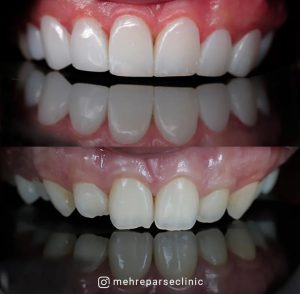 نمونه درمان کامپوزیت دندان