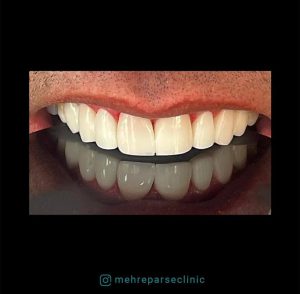 کامپوزیت دندان