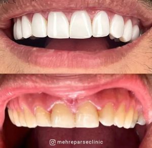 درمان کامپوزیت دندان