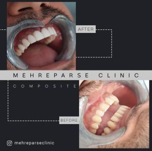قبل و بعد کامپوزیت دندان
