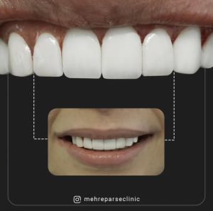 نمونه درمان کامپوزیت