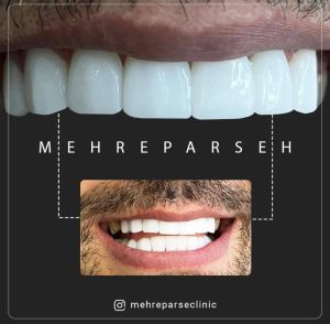 نمونه درمان کامپوزیت دندان