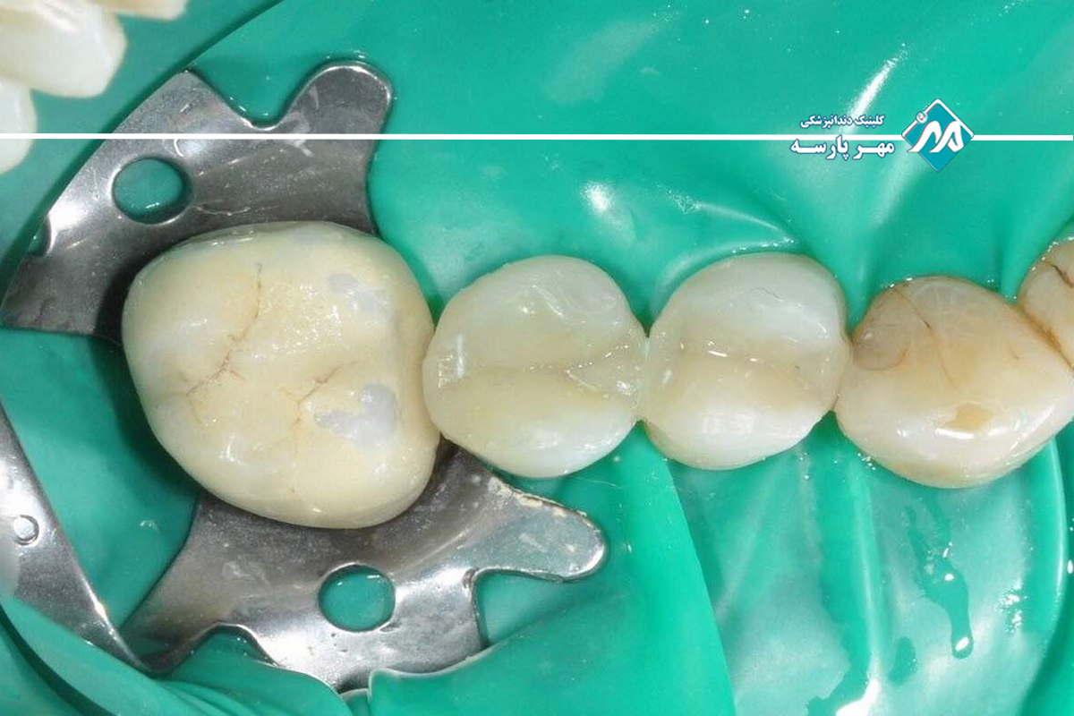 پر کردن‌ دندان (قدامی و خلفی)