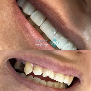 Before-and-after-dental-implants-in-installments-in-West-Tehran