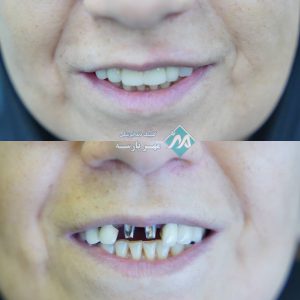 قبل و بعد ایمپلنت قسطی در غرب تهران