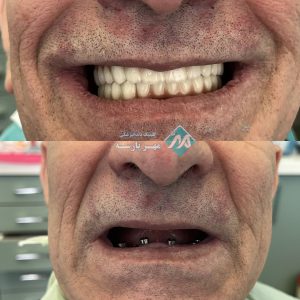 قبل و بعد ایمپلنت دندان اقساطی در غرب تهران