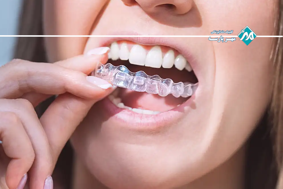 مقایسه هزینه دیمون با ارتودنسی فلزی و شفاف