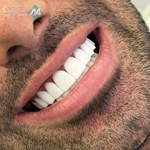 کامپوزیت دندان اقساطی در غرب تهران