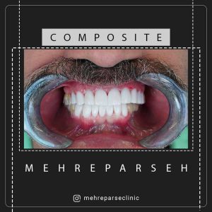 کامپوزیت دندان اقساطی