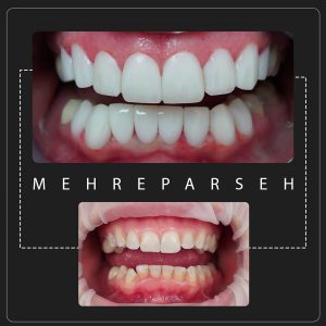 کامپوزیت اقساطی در غرب تهران