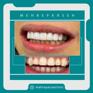 لمینت دندان اقساطی در تهران