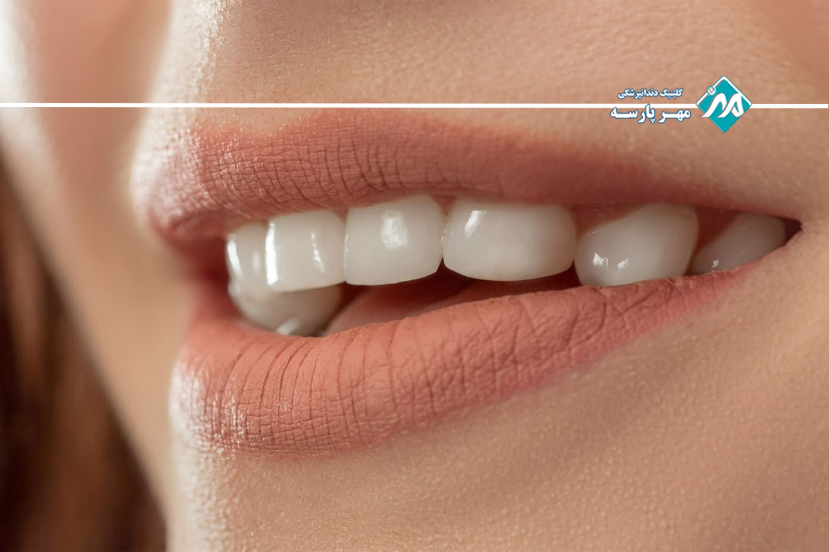 لمینت دندان اقساطی