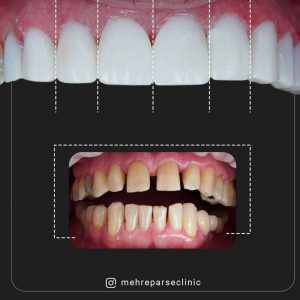 کامپوزیت اقساطی در تهران