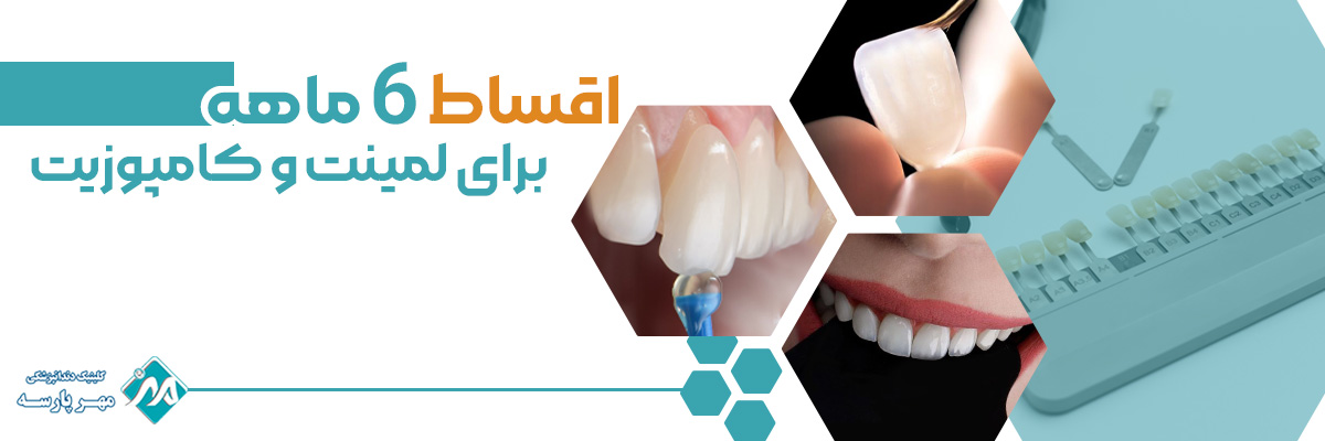 لمینت و کامپوزیت اقساطی در غرب تهران