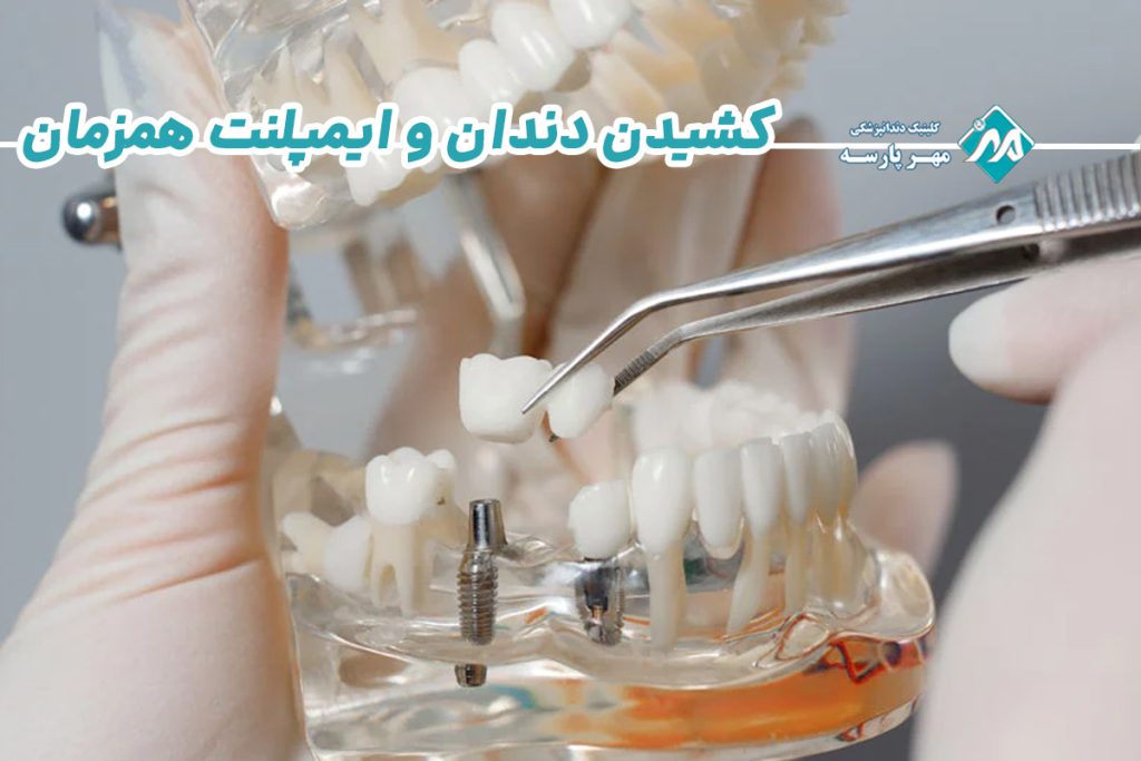 کشیدن دندان و ایمپلنت همزمان