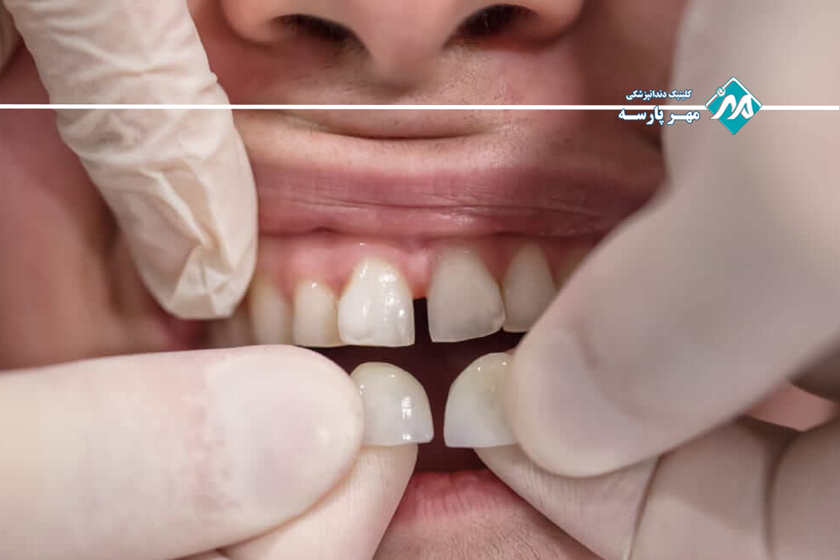 روشهای درمان تخصصی سوراخ شدن دندان