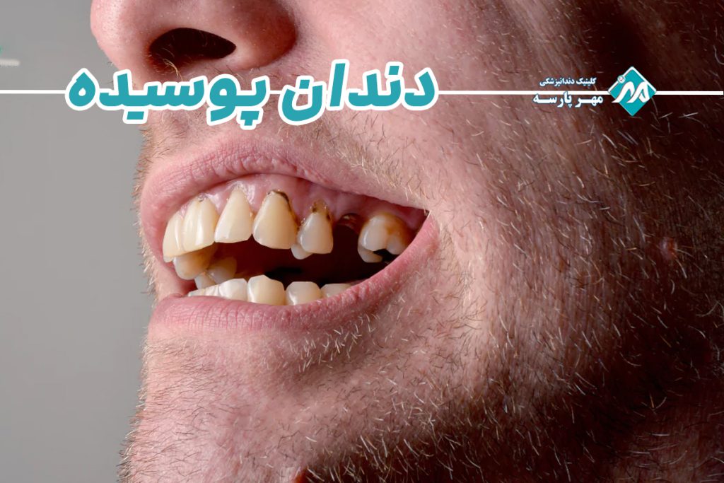 دندان پوسیده