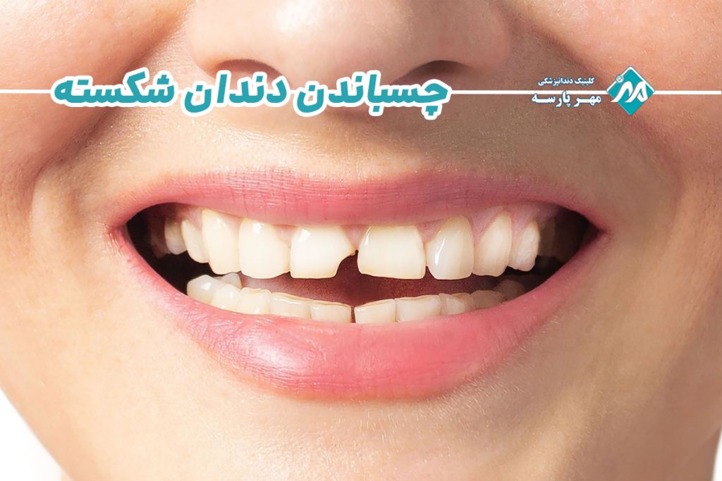 چسباندن دندان شکسته