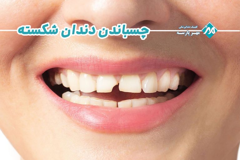 چسباندن دندان شکسته
