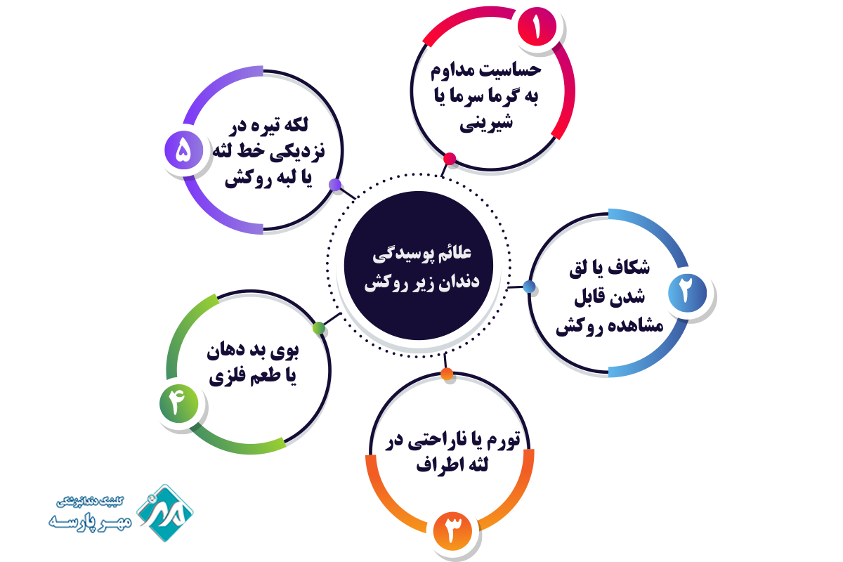 علائم پوسیدگی دندان زیر روکش