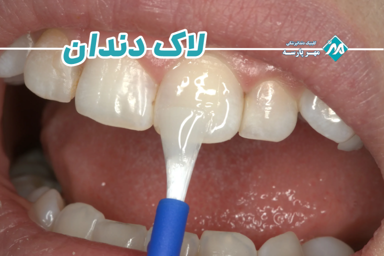 لاک دندان