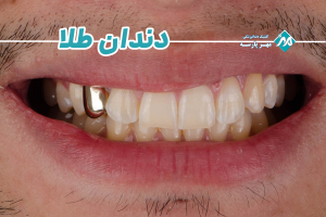 دندان طلا