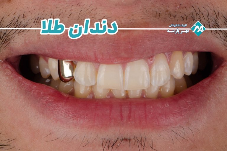 دندان طلا
