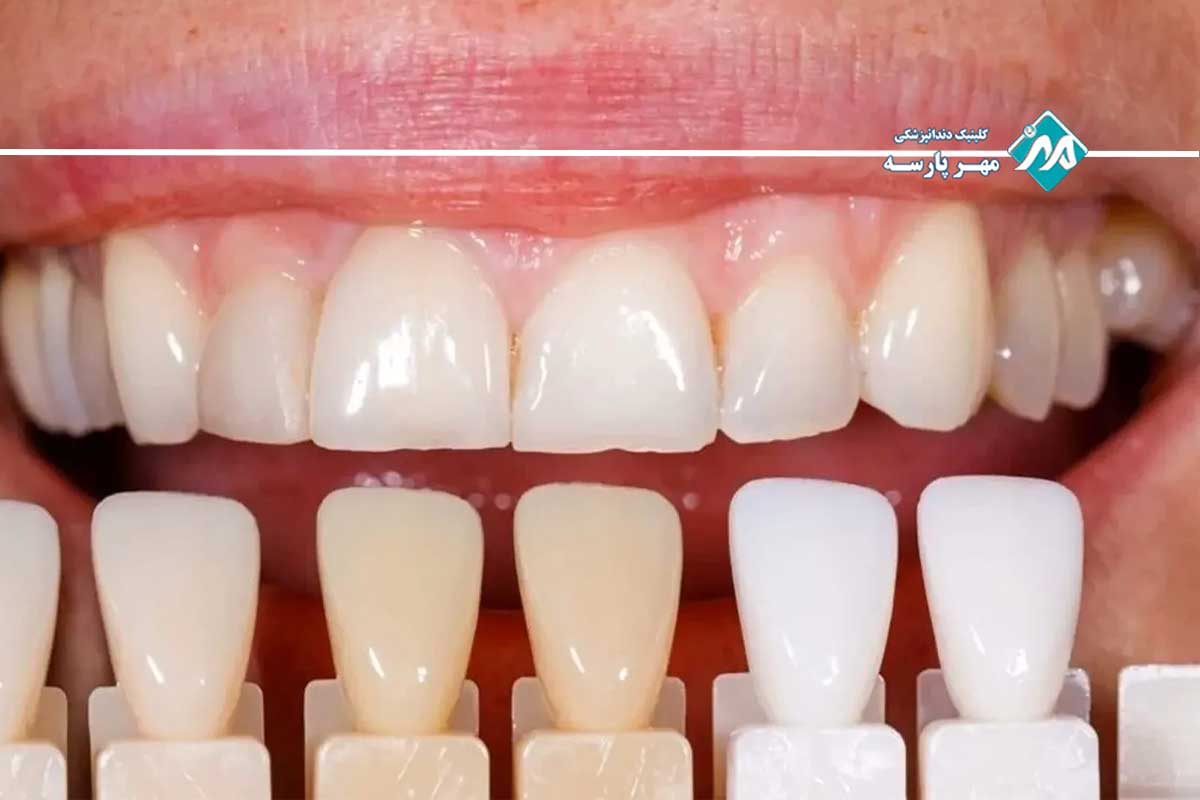 قیمت کامپوزیت دندان