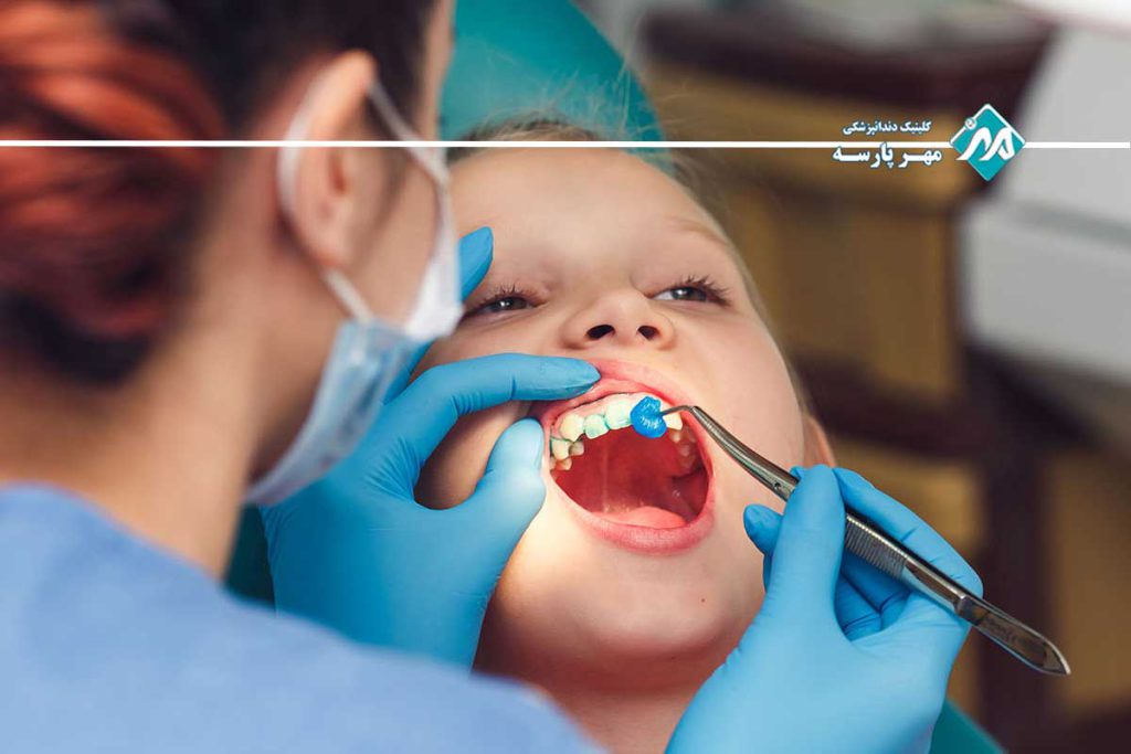 فلورایدتراپی برای کودکان