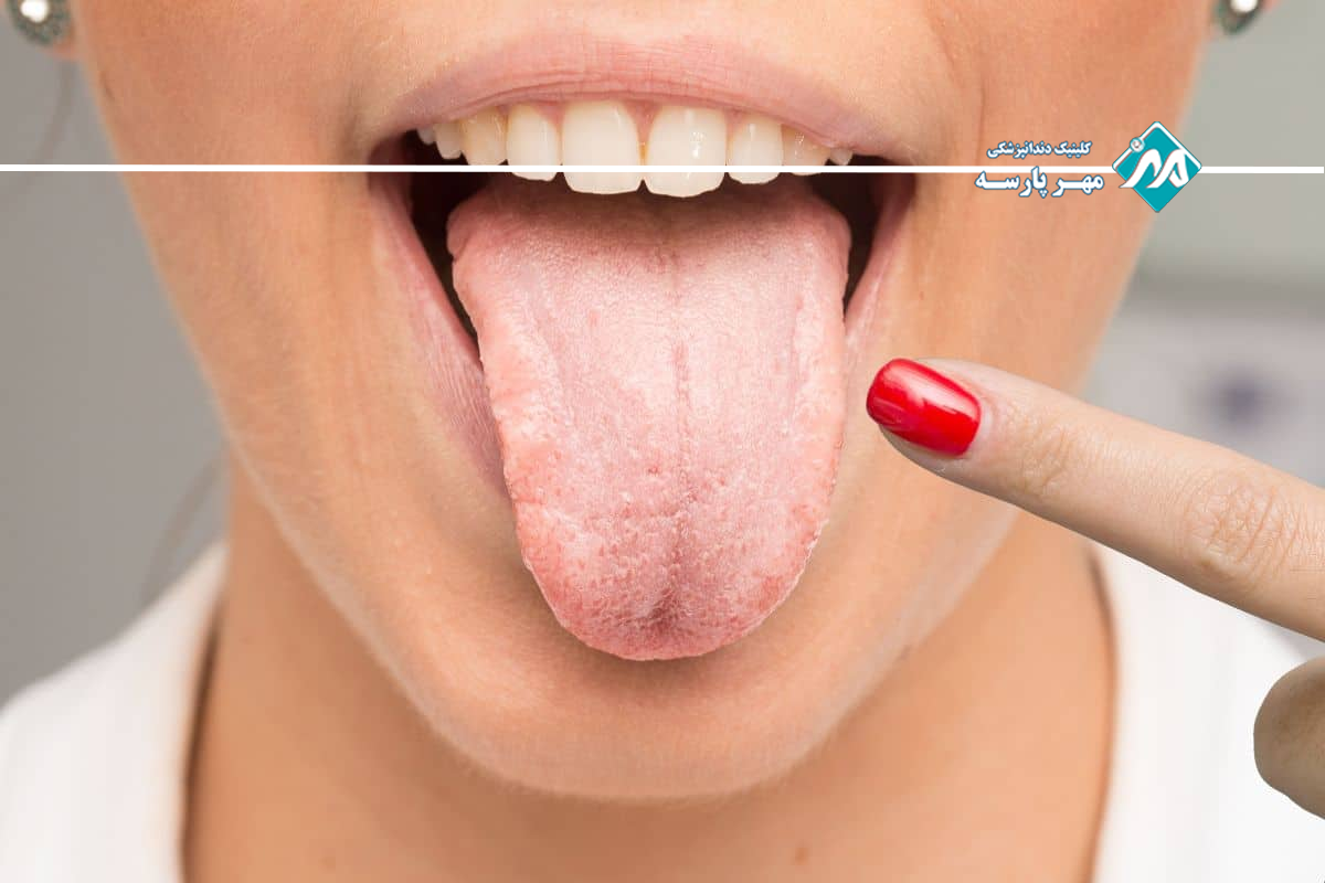 نحوه پیشگیری از خشکی دهان ناشی از دارو