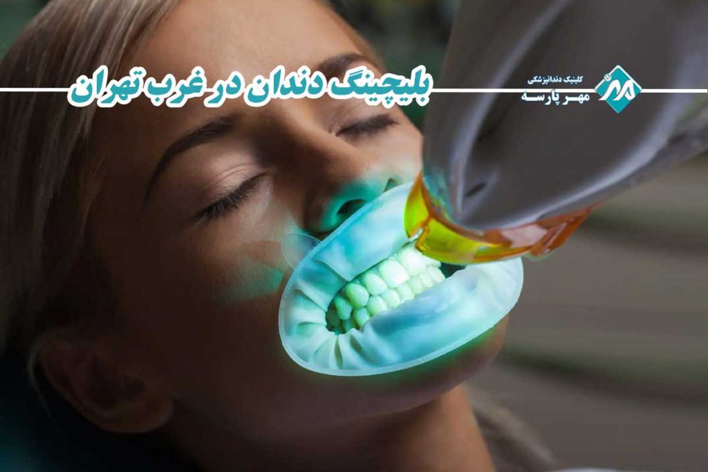 بلیچینگ دندان در غرب تهران
