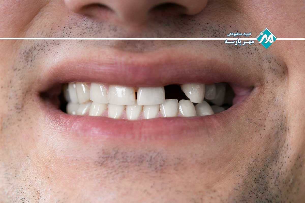بهترین روش برای جایگزین دندان از دست رفته