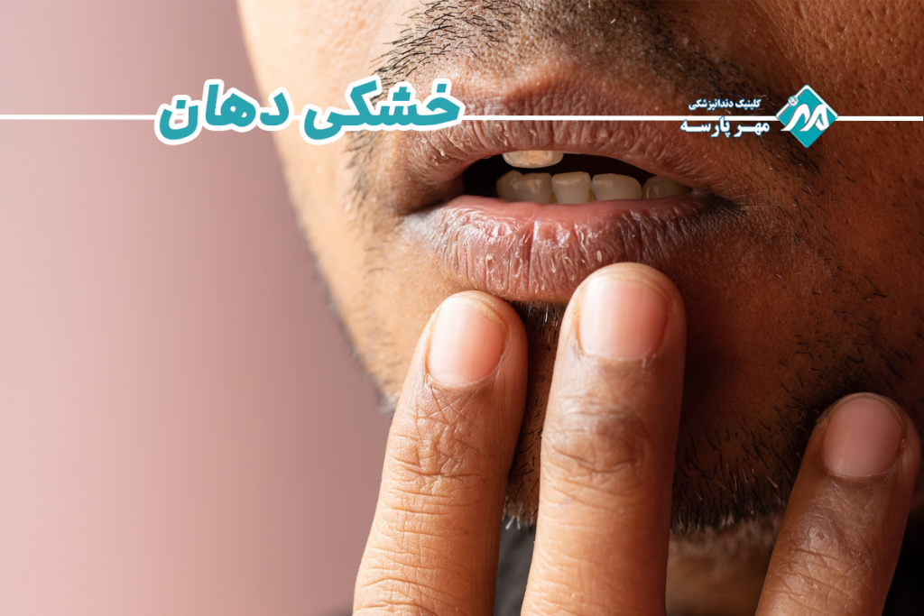 خشکی دهان