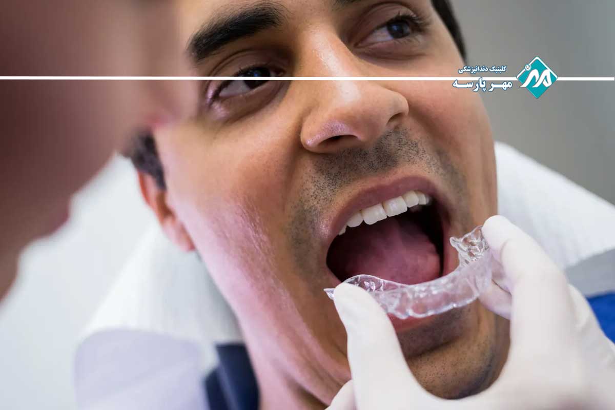 مزایا و معایب بلیچینگ دندان