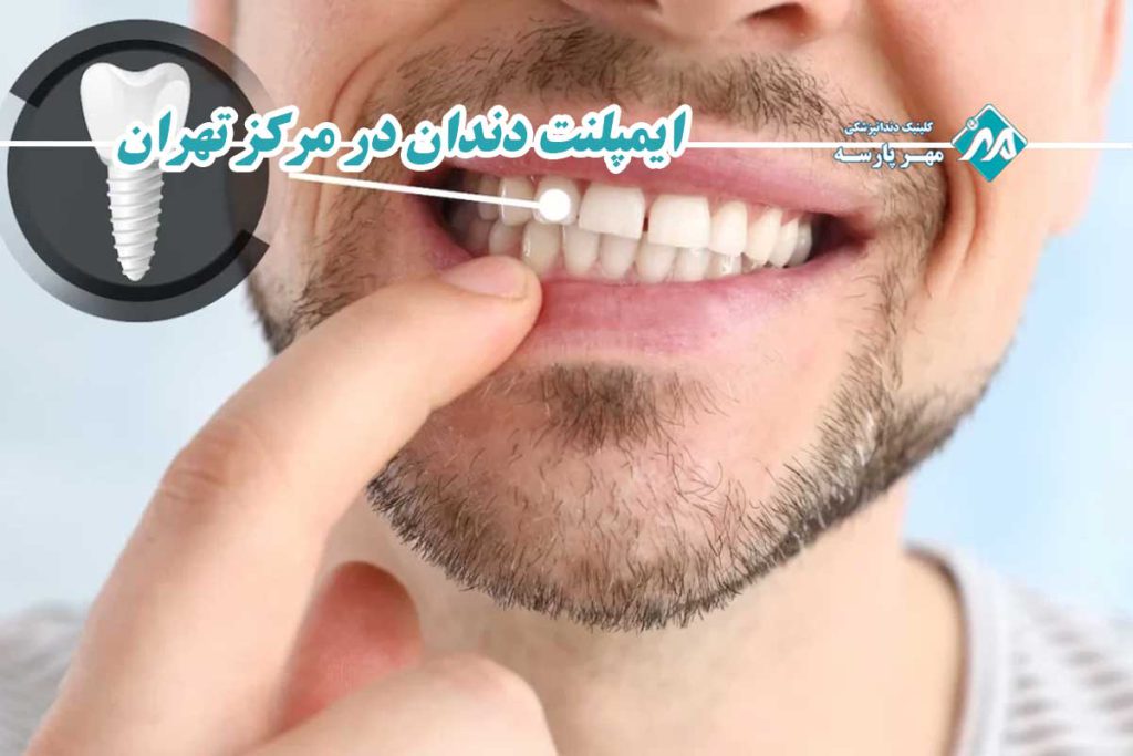 ایمپلنت دندان در مرکز تهران
