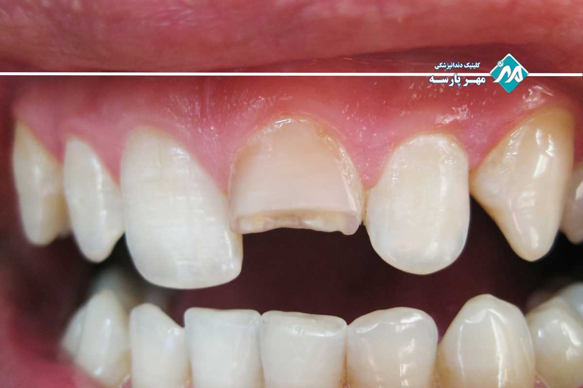 آسیب‌های دندانی