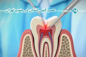 عصب کشی دندان در جنوب تهران