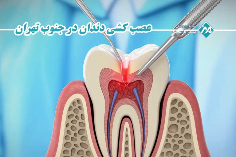 عصب کشی دندان در جنوب تهران