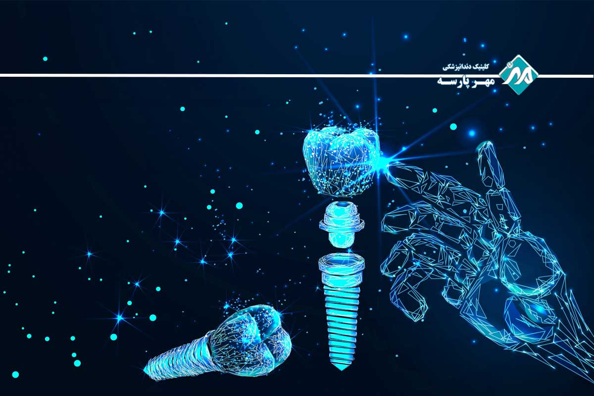 ایمپلنت دیجیتال دندان