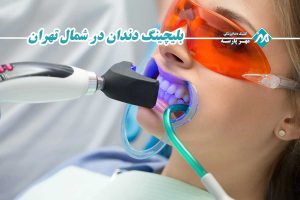 بلیچینگ دندان در شمال تهران