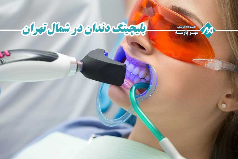 بلیچینگ دندان در شمال تهران