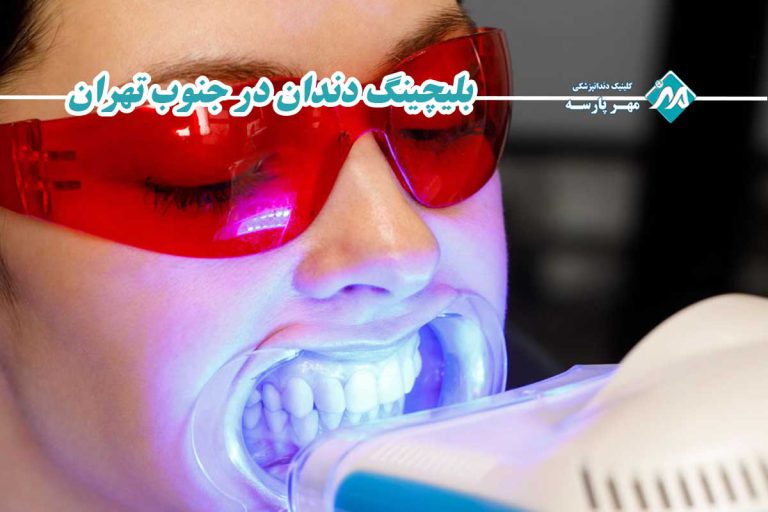 بلیچینگ دندان در جنوب تهران