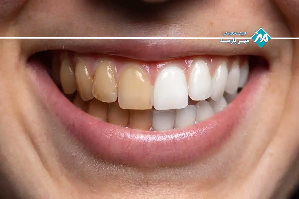 نقش وضعیت اولیه دندان در نتیجه نهایی بلیچینگ در مرکز تهران