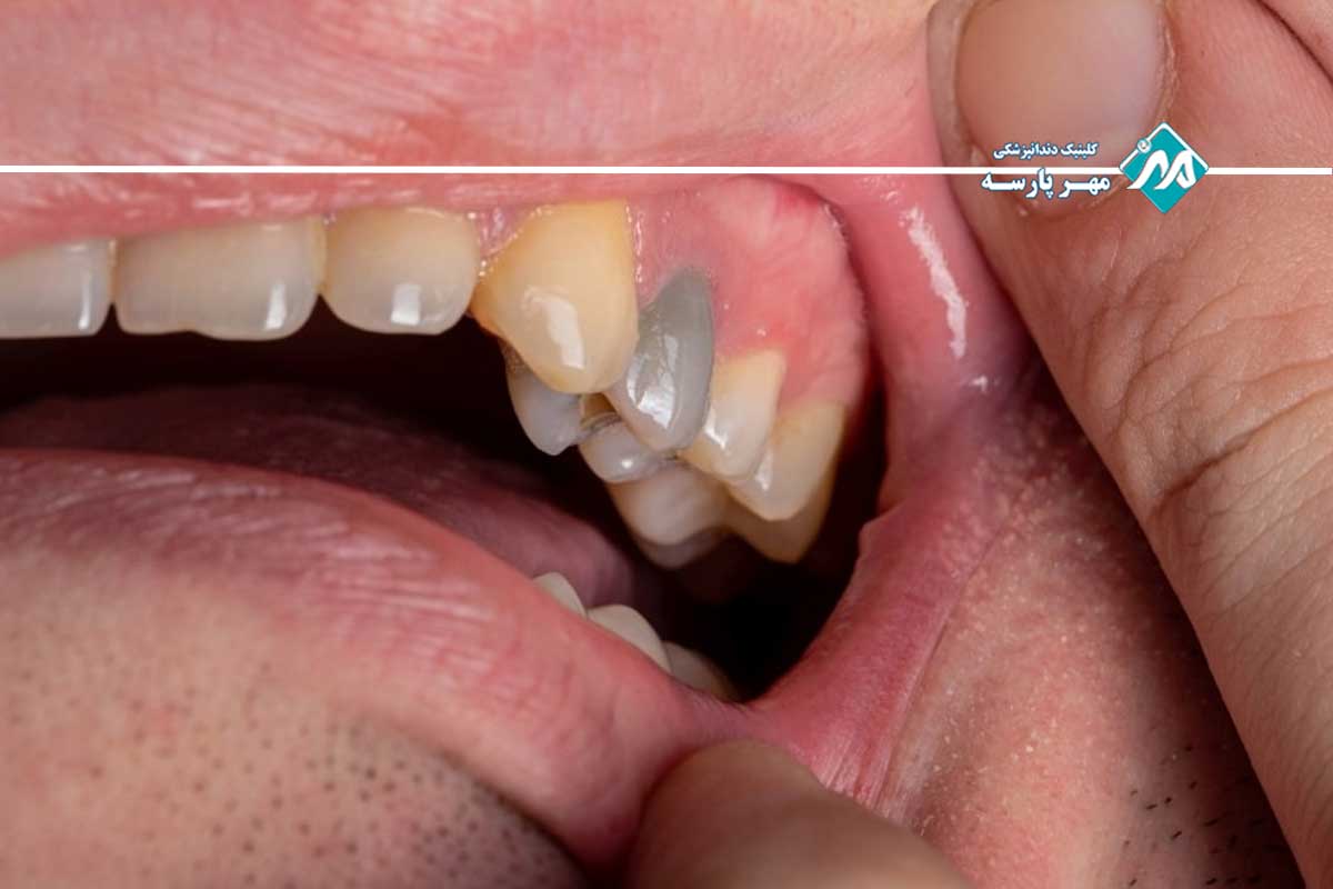 مشکلات ریشه دندان در مرکز تهران
