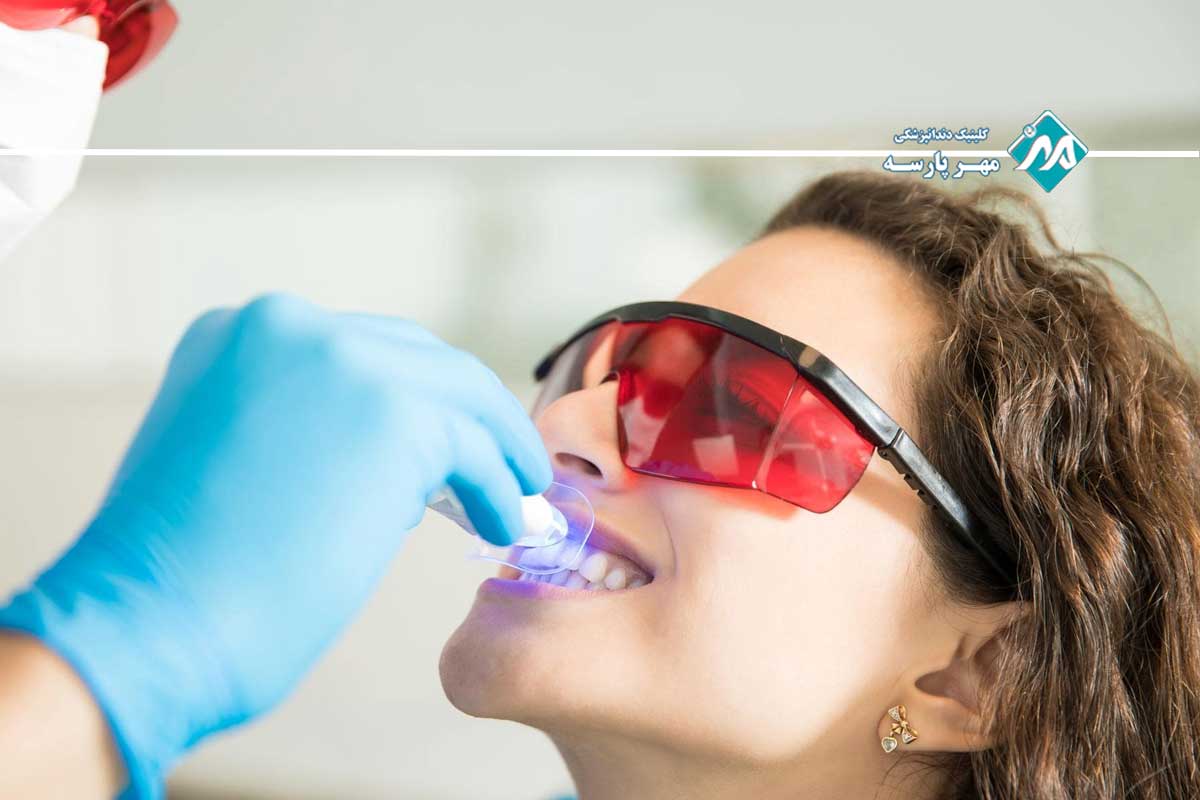انواع روشهای بلیچینگ دندان