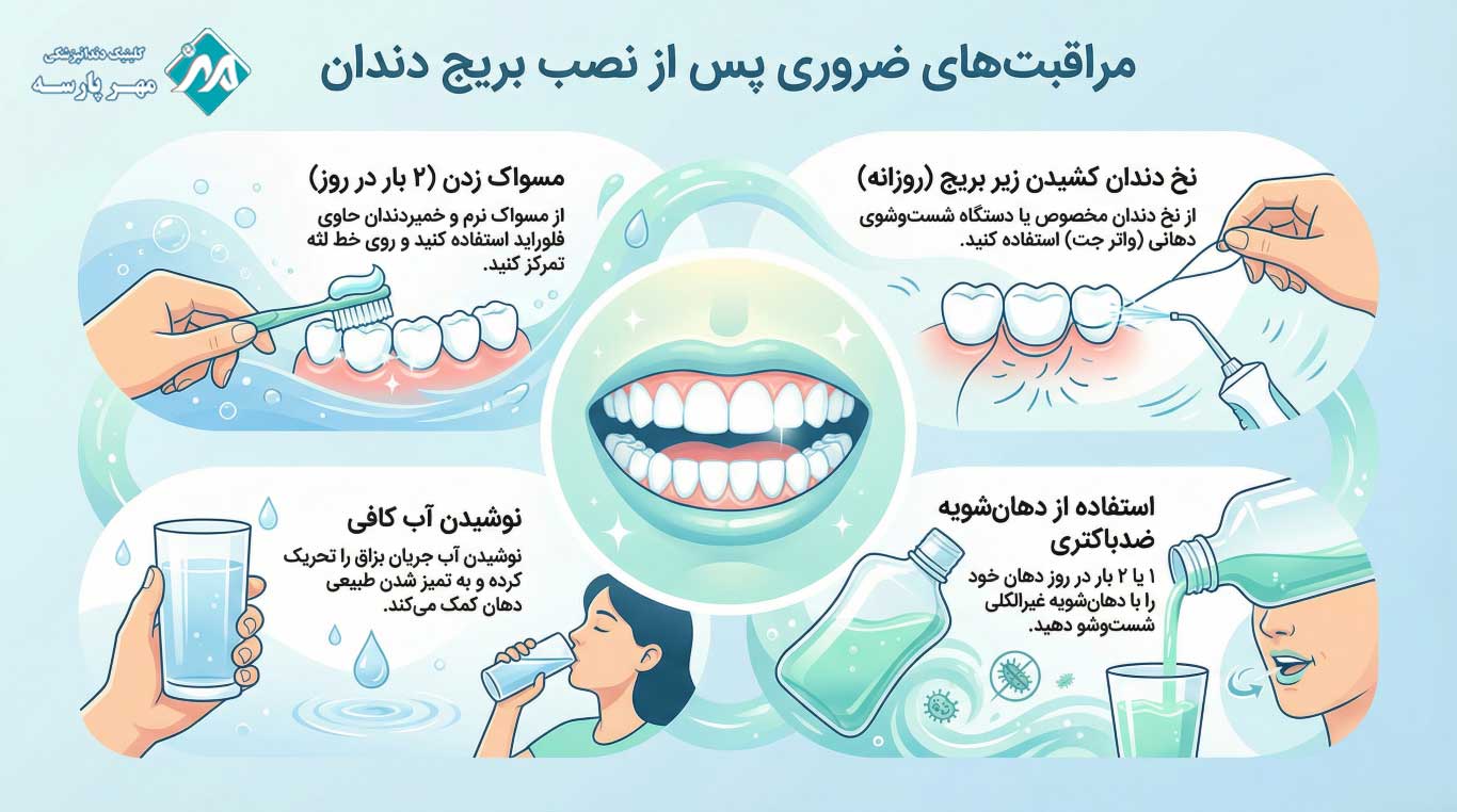 مراقبت‌های طولانی‌مدت بعد از نصب بریج دندان