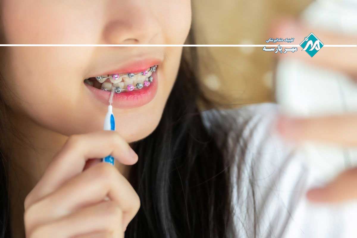 مراقبت صحیح در طول ارتودنسی